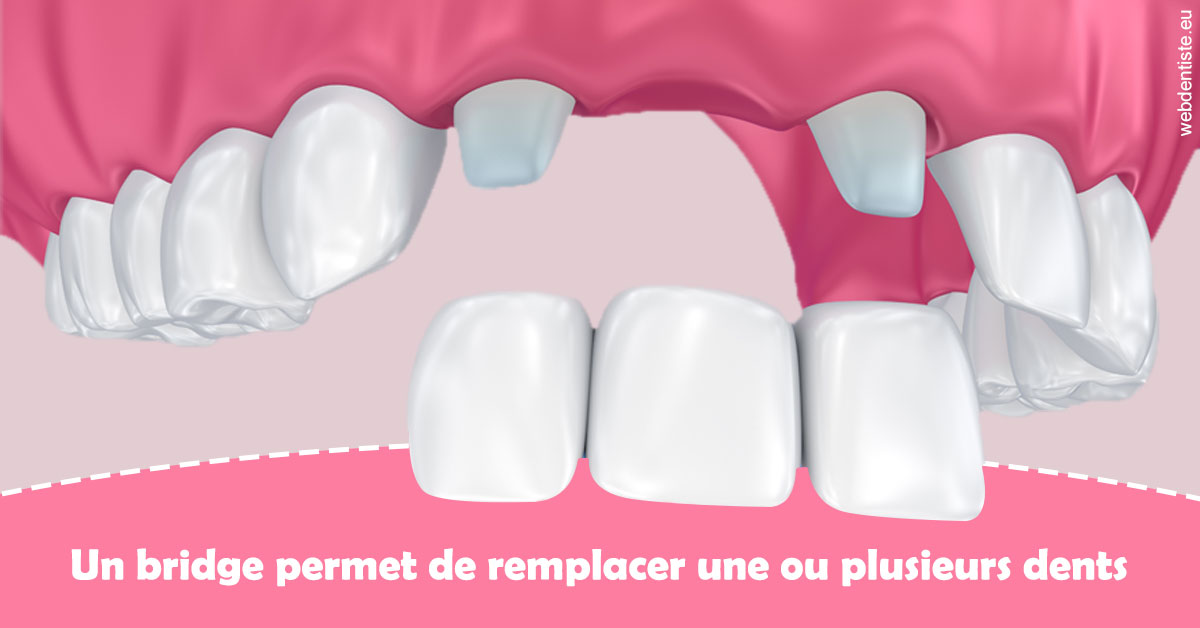 https://dr-lacaille-dominique.chirurgiens-dentistes.fr/Bridge remplacer dents 2