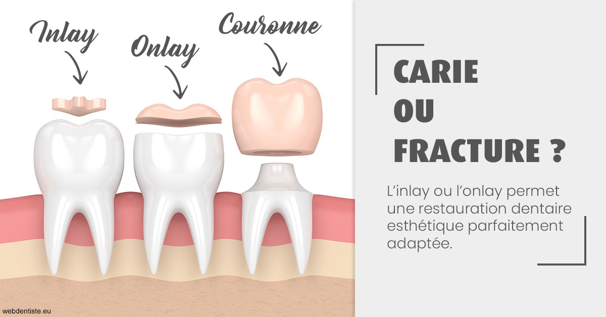 https://dr-lacaille-dominique.chirurgiens-dentistes.fr/T2 2023 - Carie ou fracture 1