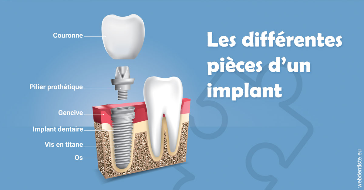 https://dr-lacaille-dominique.chirurgiens-dentistes.fr/Les différentes pièces d’un implant 1